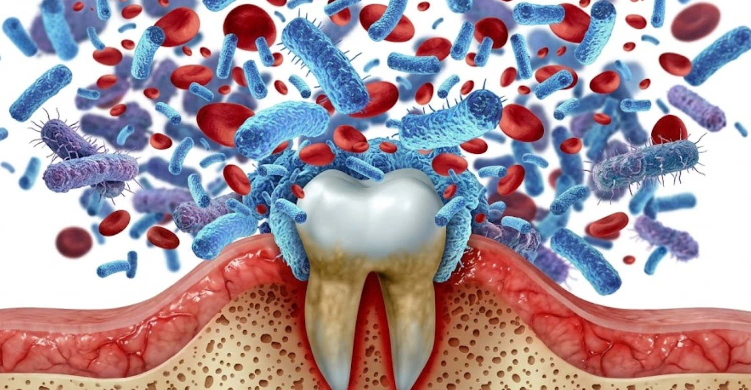 Bacteriophage Therapy for Gum Disease 2